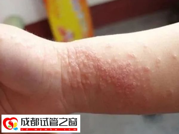 新生儿脸上冒湿疹不用慌，家庭护理小妙招轻松处理(图2)